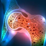 El tratamiento natural que reduce el riesgo de osteoporosis según nuevos estudios